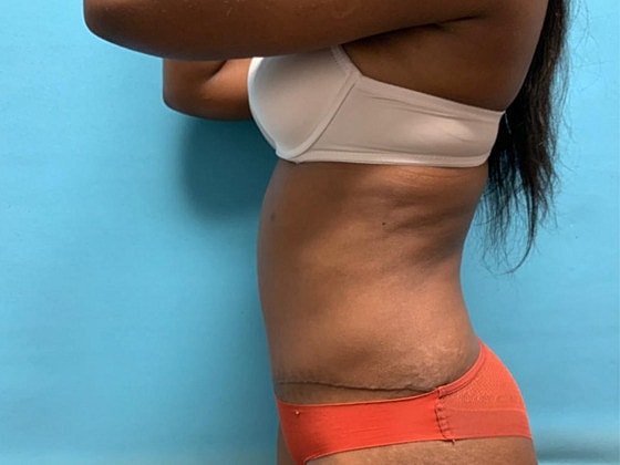Tummy Tuck Before & After