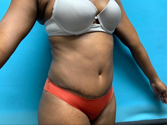 Tummy Tuck Before & After