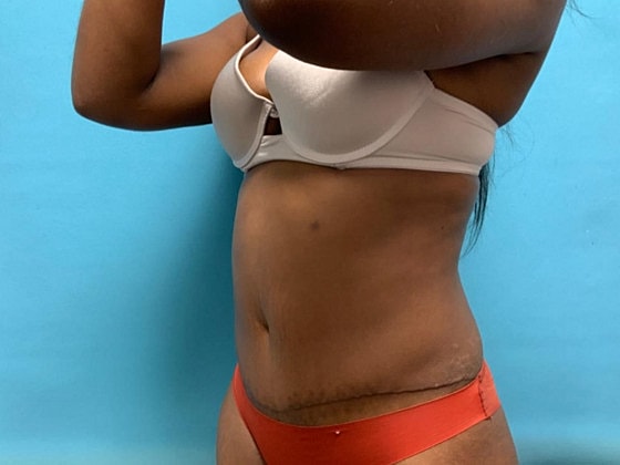 Tummy Tuck Before & After
