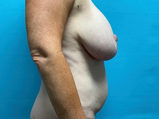 Tummy Tuck Before & After