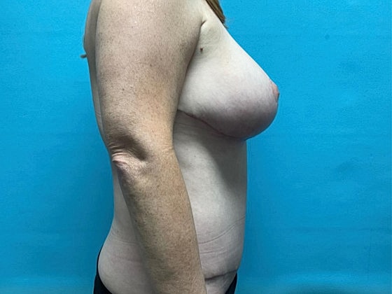 Tummy Tuck Before & After