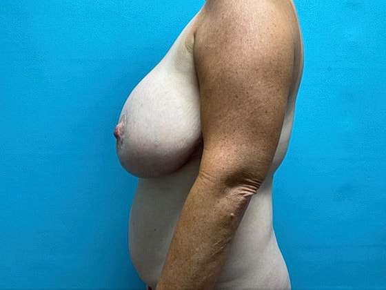 Tummy Tuck Before & After