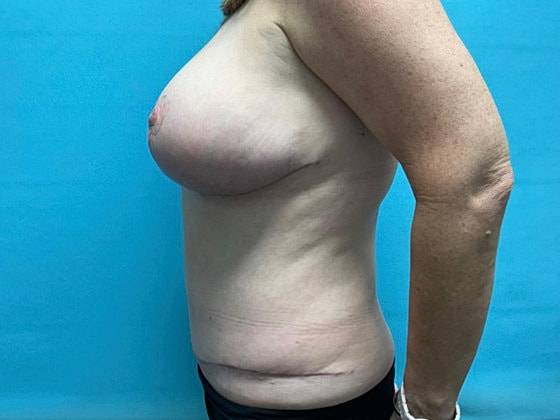 Tummy Tuck Before & After