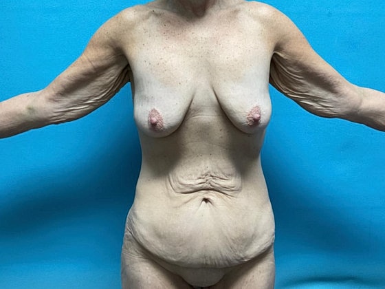 Tummy Tuck Before & After