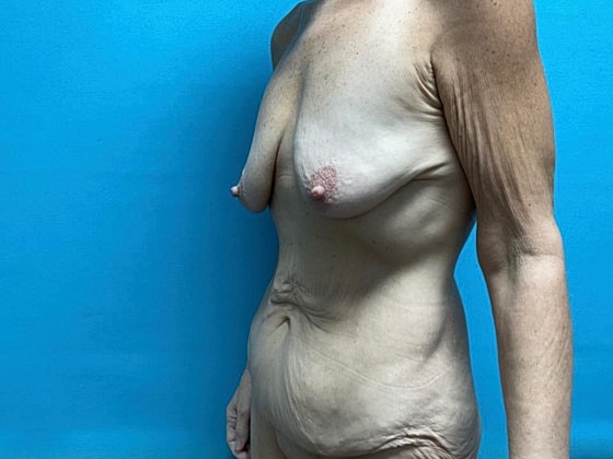 Tummy Tuck Before & After