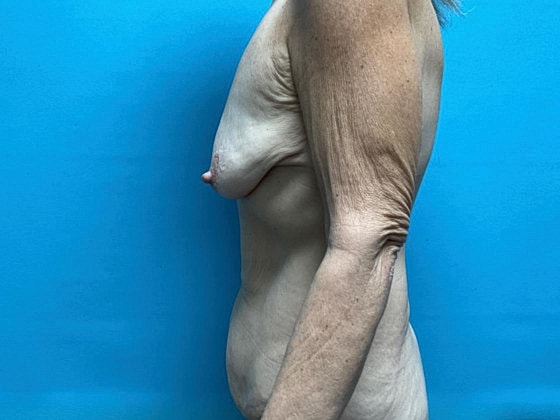 Tummy Tuck Before & After