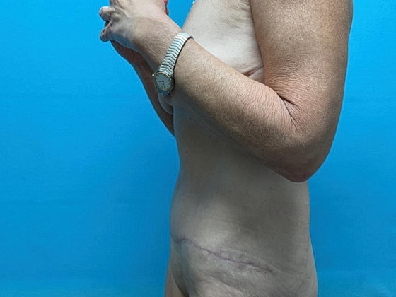 Tummy Tuck Before & After