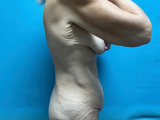 Tummy Tuck Before & After