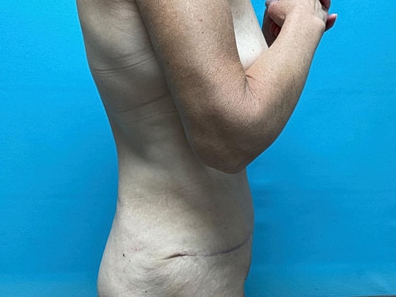 Tummy Tuck Before & After