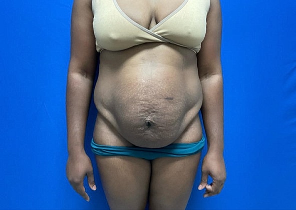 Tummy Tuck Before & After