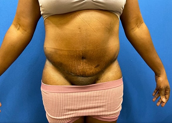 Tummy Tuck Before & After