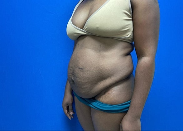 Tummy Tuck Before & After