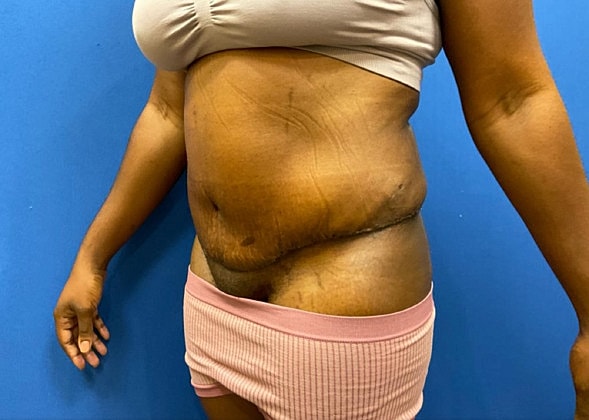 Tummy Tuck Before & After
