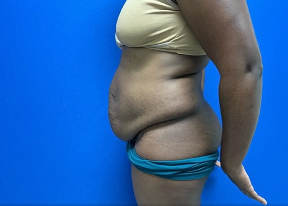 Tummy Tuck Before & After