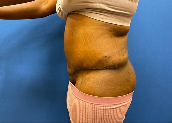 Tummy Tuck Before & After