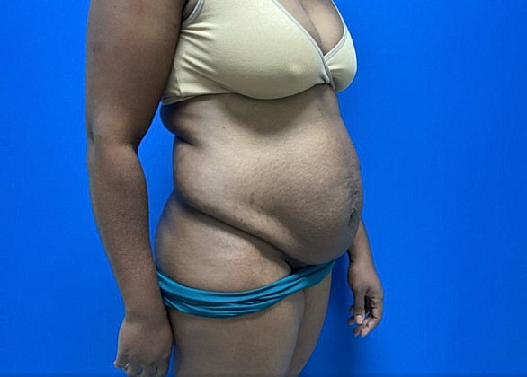 Tummy Tuck Before & After