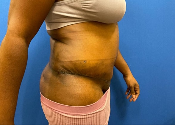 Tummy Tuck Before & After