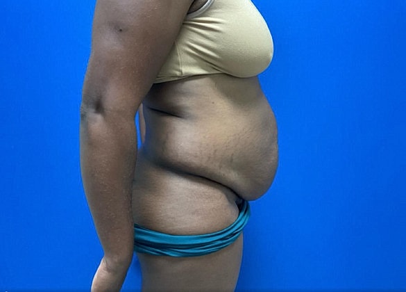 Tummy Tuck Before & After