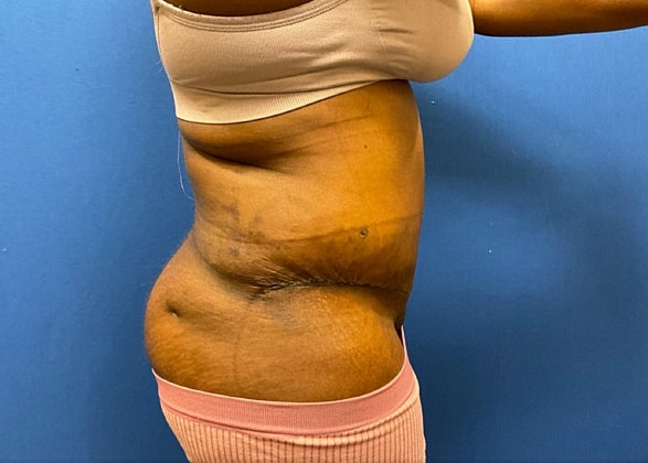Tummy Tuck Before & After