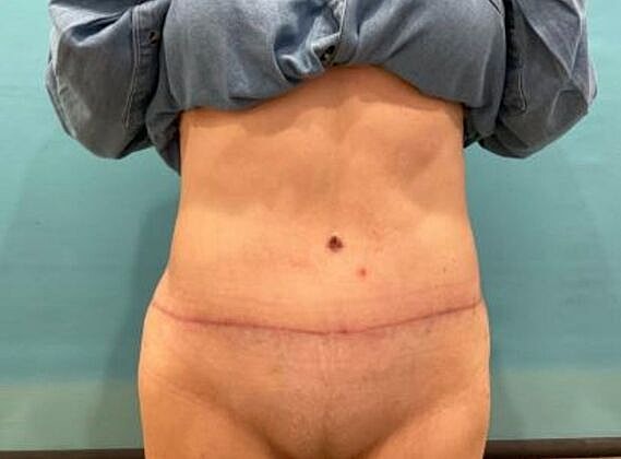 Tummy Tuck Before & After