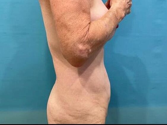 Tummy Tuck Before & After