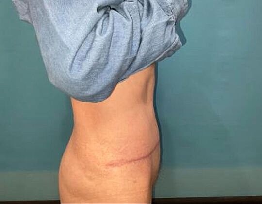 Tummy Tuck Before & After