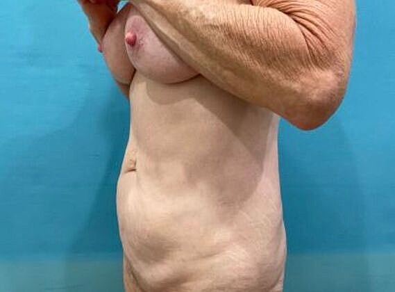 Tummy Tuck Before & After