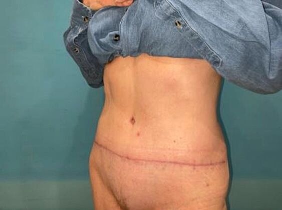 Tummy Tuck Before & After