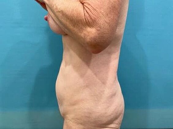Tummy Tuck Before & After