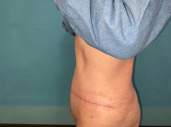 Tummy Tuck Before & After