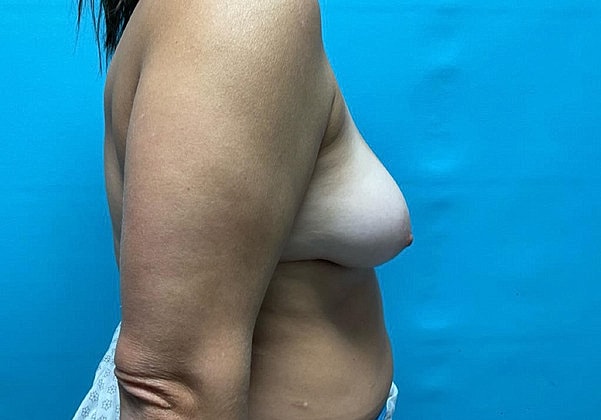 Breast Augmentation Before & After
