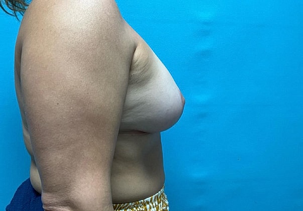 Breast Augmentation Before & After