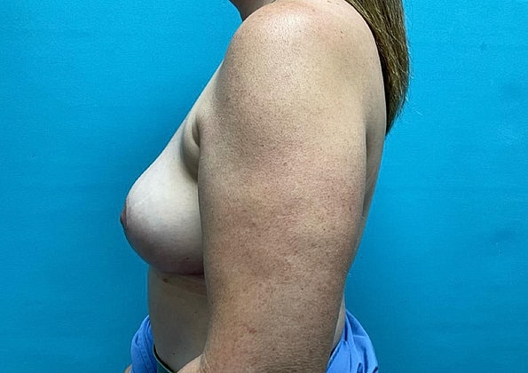 Breast Augmentation Before & After