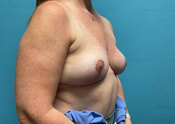 Breast Augmentation Before & After