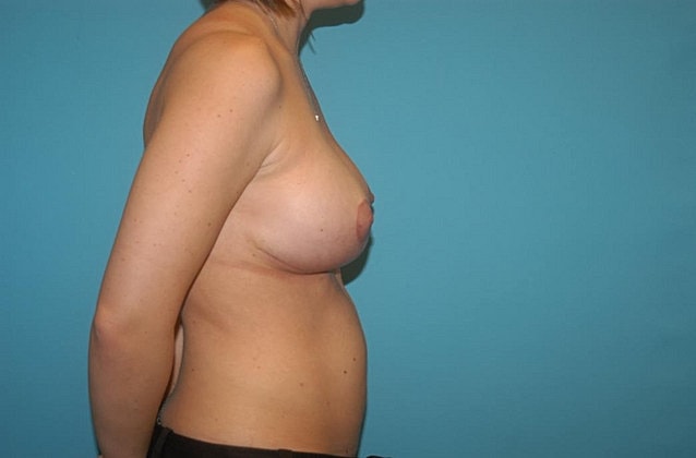 Breast Augmentation Before & After