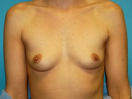 Breast Augmentation Before & After