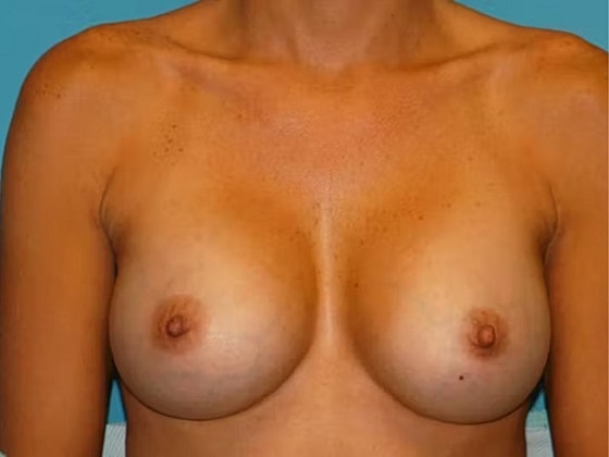 Breast Augmentation Before & After