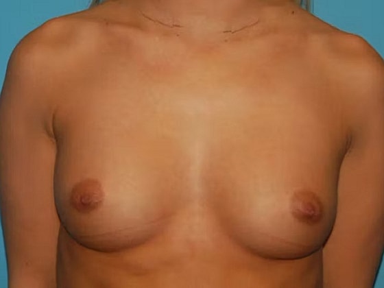Breast Augmentation Before & After