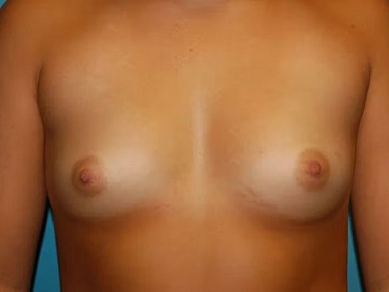 Breast Augmentation Before & After