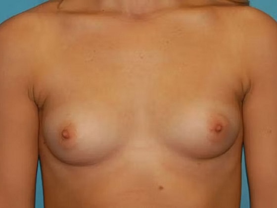 Breast Augmentation Before & After