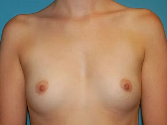 Breast Augmentation Before & After