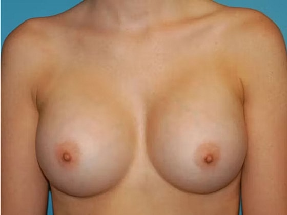 Breast Augmentation Before & After
