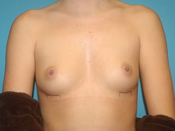 Breast Augmentation Before & After