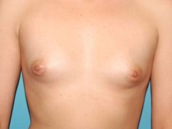 Breast Augmentation Before & After