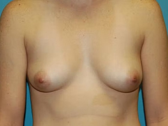 Breast Augmentation Before & After