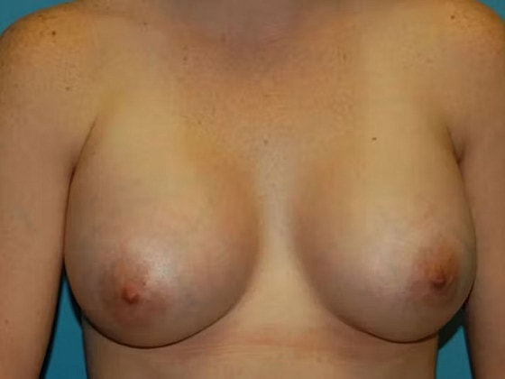 Breast Augmentation Before & After