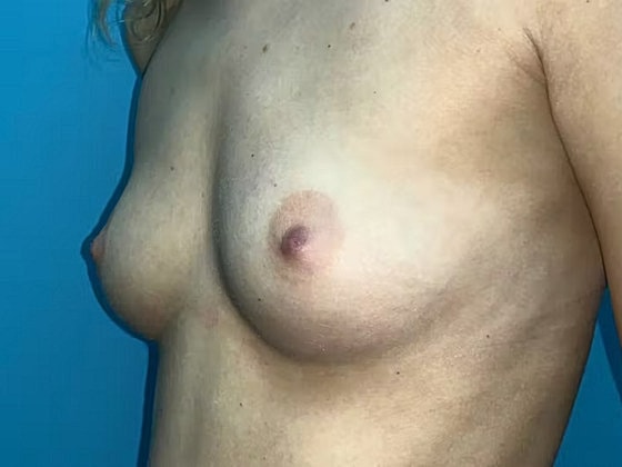 Breast Augmentation Before & After