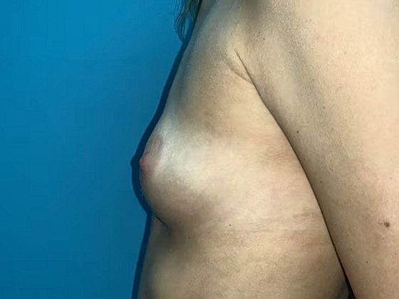 Breast Augmentation Before & After