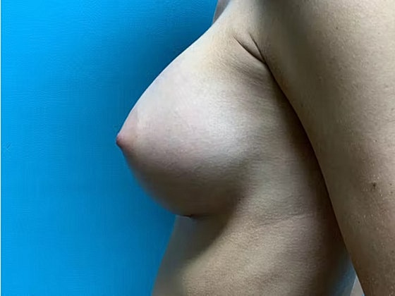 Breast Augmentation Before & After