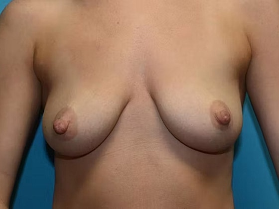 Breast Augmentation Before & After